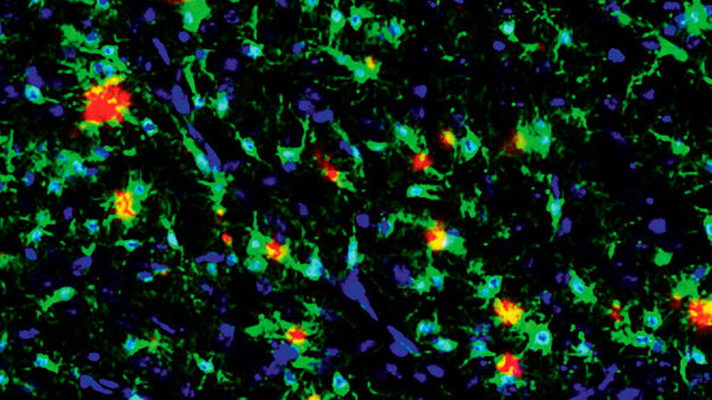 Abb. 1: Mikroskopische Fluoreszenzaufnahme der Alzheimer-Erkrankung im Mausmodell: Die Aufnahme stellt Amyloid-beta(Aβ)-Ablagerungen (Thiazin Rot, rot) und Mikroglia (Iba1, grün) im AD-Tiermodell dar. Die Zellkerne sind durch DAPI blau gefärbt.\r\n