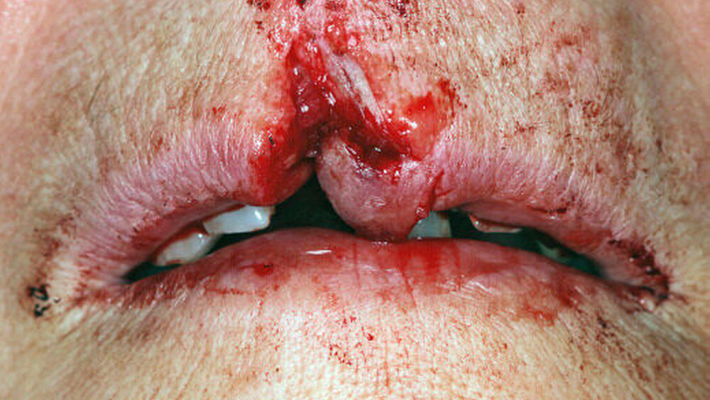 Abbildung 2: Avulsion 11, laterale Luxation 21 und komplexe Weichteilverletzung mit Unterbrechung der Lippen-Rot-Weiß-Grenze und des Philtrums: Die Zahnschäden können nach den genannten Richtlinien versorgt werden, die Versorgung der Lippenverletzung gehört in die Hände eines versierten Chirurgen. Eine ungenaue Adaptation der Lippen-Rot-Weiß-Grenze und des Philtrums führt zur ästhetischen Einbuße. |