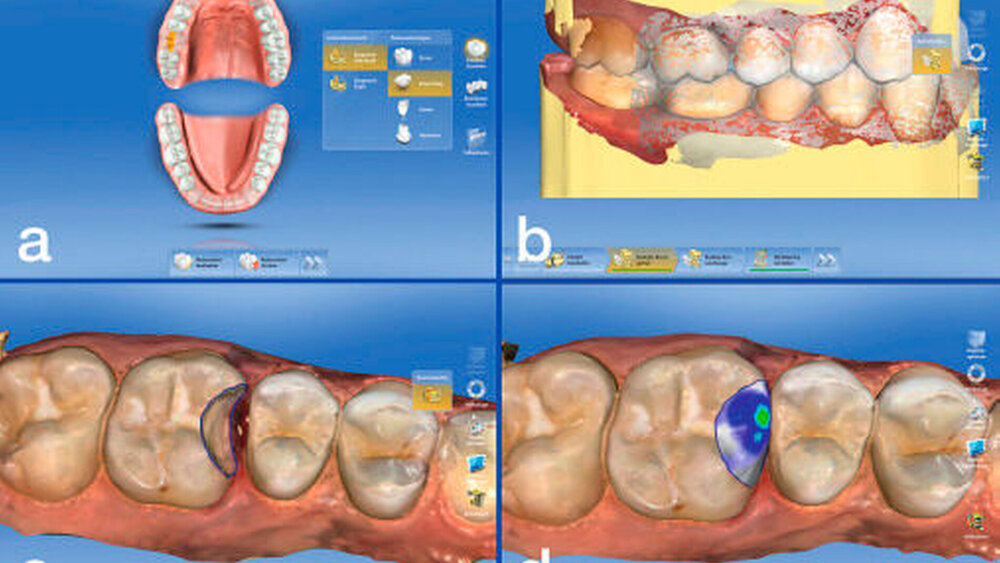 Abbildung 9: Mithilfe des Cerec-Systems wurde ein minimalinvasives zweiflächiges Inlay intraoral abgeformt (Cerec Omnicam) und anschließend aus der Hybridkeramik Lava Ultimate geplant und hergestellt. |