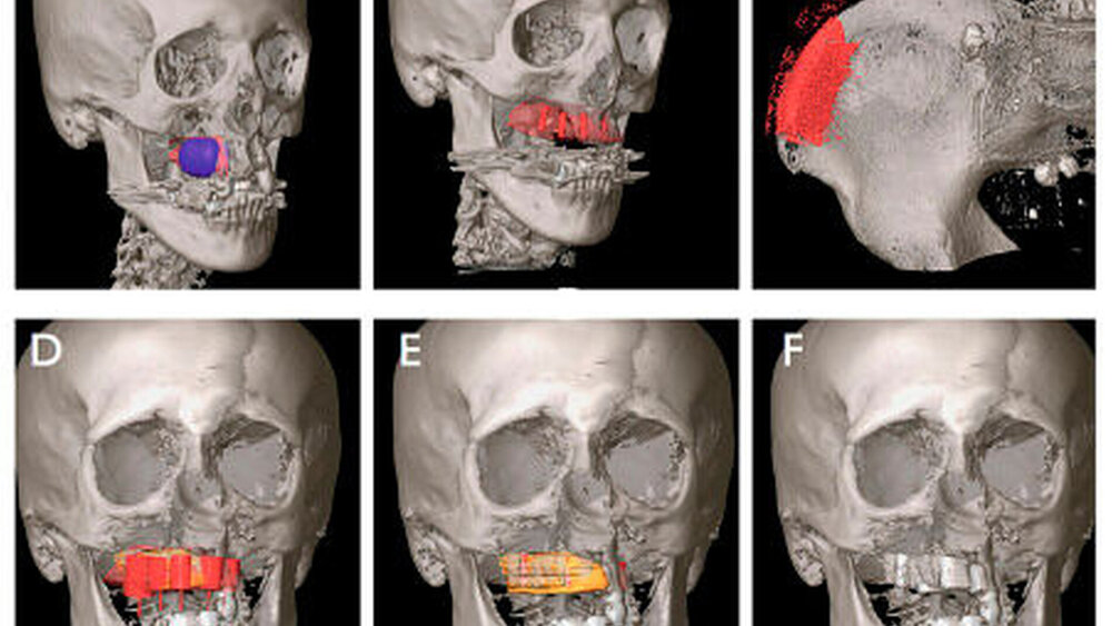 Abbildung 3: Segmentierter Tumor mit Sicherheitsabstand (violett) und geplante Resektionsgrenzen (rot) (A); simulierter Bedarf an Knochen im Oberkiefer mit simulierten dentalen Implantaten (rot) (B); segmentiertes Beckenkammtransplantat am rechten Becken (rot) (C); importierte Hohlzylinder simulieren den Knochenbedarf (rot) und das Beckenkammtransplantat (gelb) (D); transplantiertes Beckenkammtransplantat und simulierte dentale Implantate (rot) (E); postoperatives DVT nach dentaler Implantation (F) |