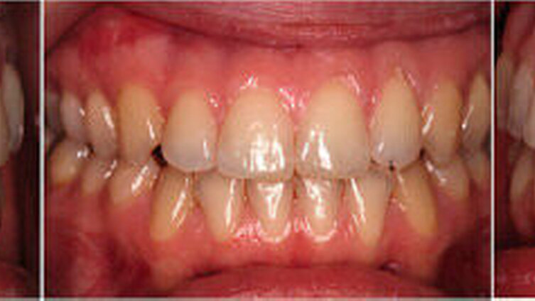 Abbildung 7: Intraoraler Befund am Ende der Behandlung |