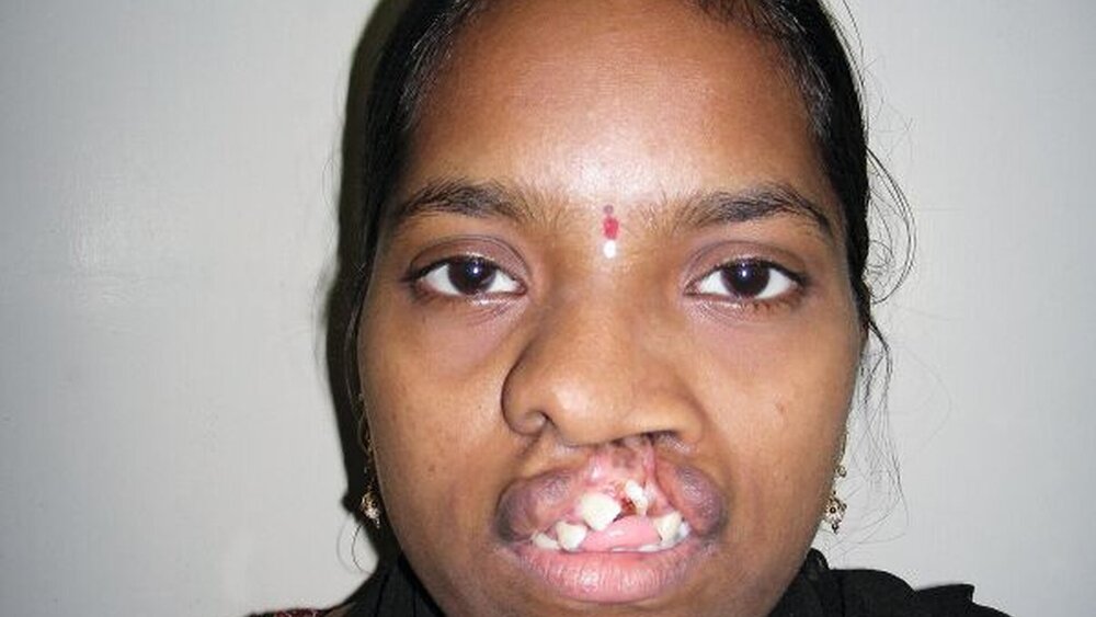 Abbildung 1: Die 20-jährige Patientin in der Frontalansicht zum Zeitpunkt der Erstvorstellung: Es imponiert eine linksseitige Lippenspalte mit offenem Biss und Protrusion der Frontzähne. Der linke Nasenflügel ist deformiert, die Nasenspitze nach kontralateral verlagert. |