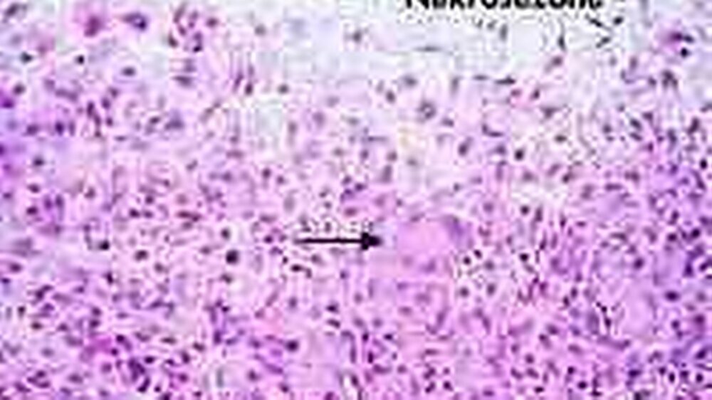 Abbildung 3: Die histologische Abbildung zeigt einen Ausschnitt aus dem Randwall eines Granuloms. Die Nekrosezone ist umgeben von einem Lymphozytenwall mit Epitheloidzellen und mehrkernigen histiozytären Riesenzellen vom Langhans-Typ ( ➞ ).