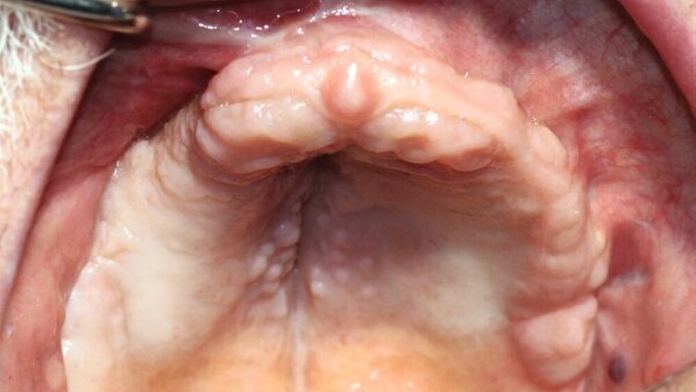 Abbildung 7: Klinischer Zustand drei Monate nach OP mit deutlichem knöchernem Defizit und Vestibulumabflachung im ersten Quadranten. |