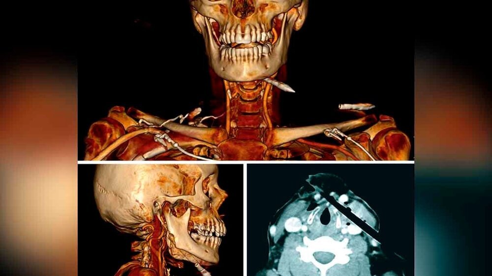 Abb. 1: CT Hals-Thorax mit Kontrastmittel:a: 3-D-Rekonstruktion, Ansicht von frontal mit den zwei Armbrustbolzen: Im CT sind lediglich die metallischen Bolzenspitzen zu sehen. Der Schaft der Bolzen besteht aus Karbonfasern und ist nicht radioopak. Der kra