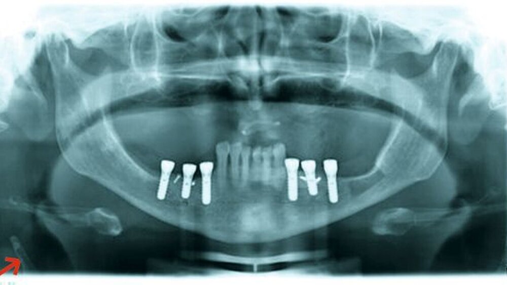 Abbildung: Projektion atherosklerotischer Veränderungen der A. carotis in der Panoramaschichtaufnahme (siehe Pfeil). |