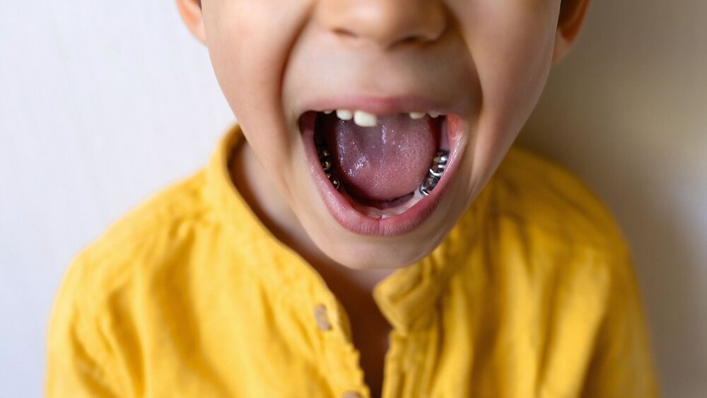 Dental care concept. Stainless steel crown a silver cap used for restoring children's teeth
