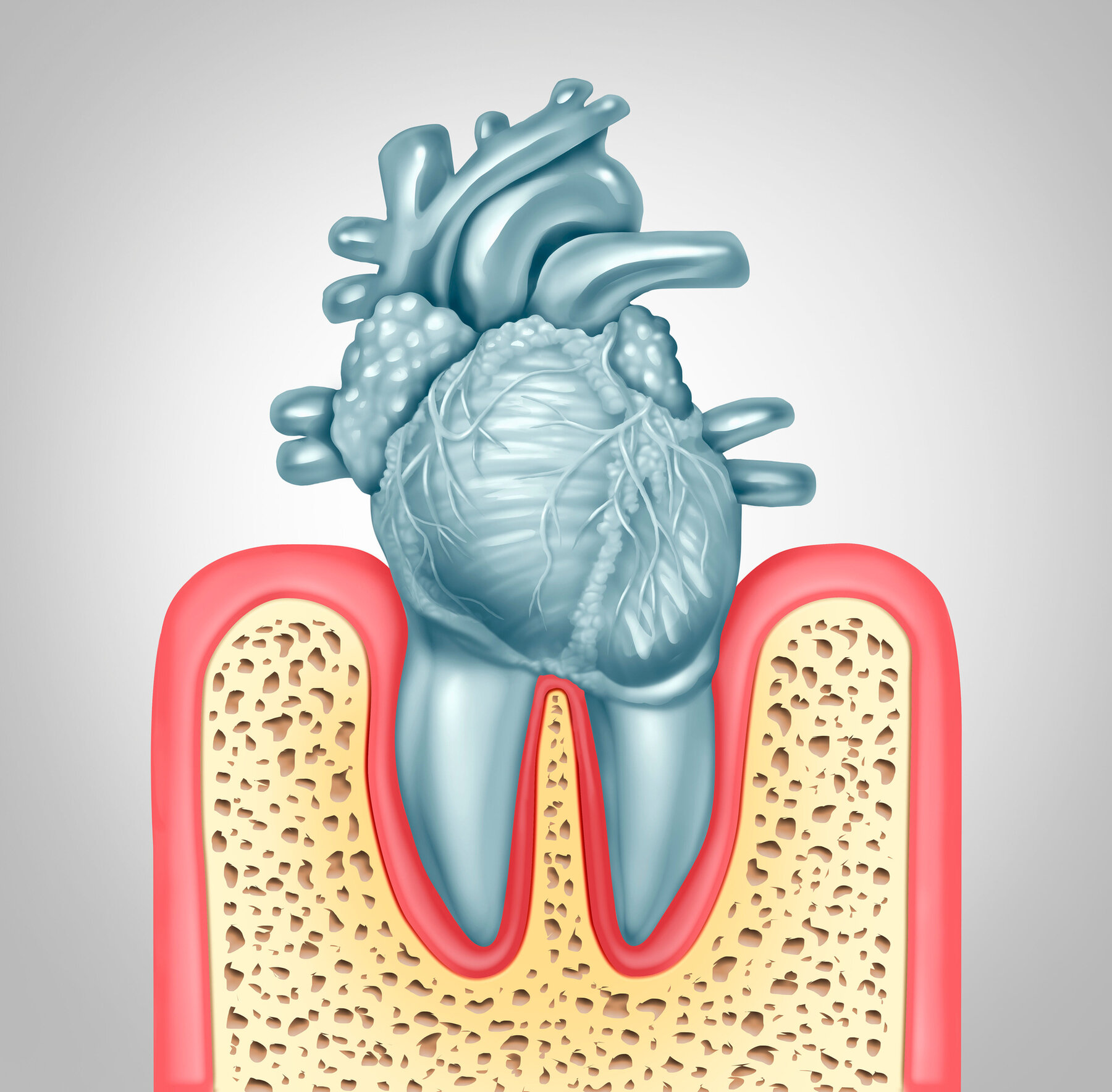 Parodontitis und Herzerkrankungen