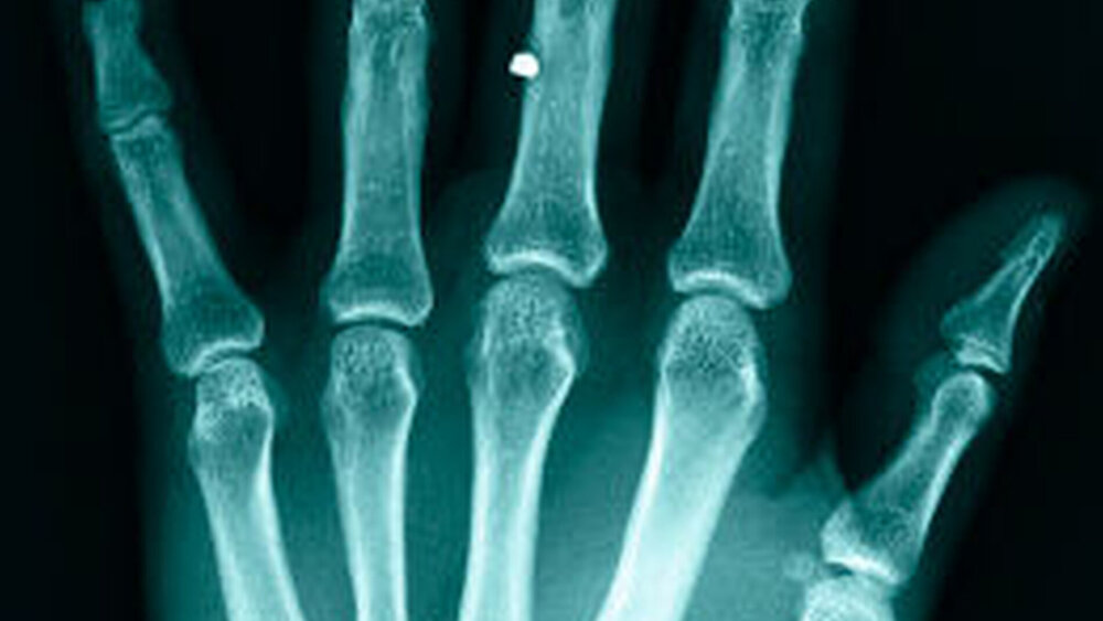 Abbildung 3: Röntgen der Hand mit Projektil im Bereich des linken Mittelfingers |