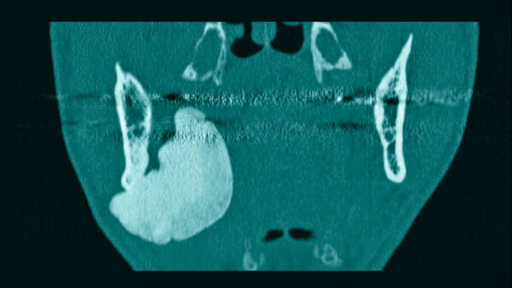 Abbildung 4: In der axialen Schicht ist die Verlagerung der Anatomie, welche insbesondere zu einer Vorwölbung der rechtsseitigen Oropharynxseitenwand führt, gut erkennbar. |