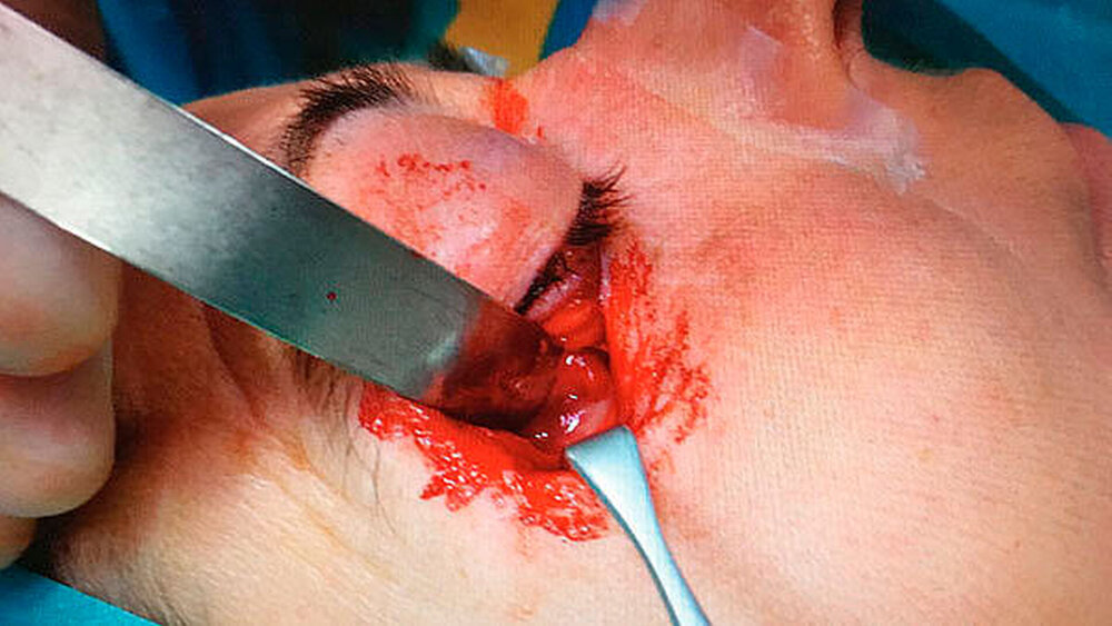 Abbildungen 4 und 5: Intraoperative Darstellung. Der Zugang zur Orbita erfolgte von subziliär durch das Septum orbitale. Nach Spreizen mit einer Schere entleerte sich massiv Pus. |