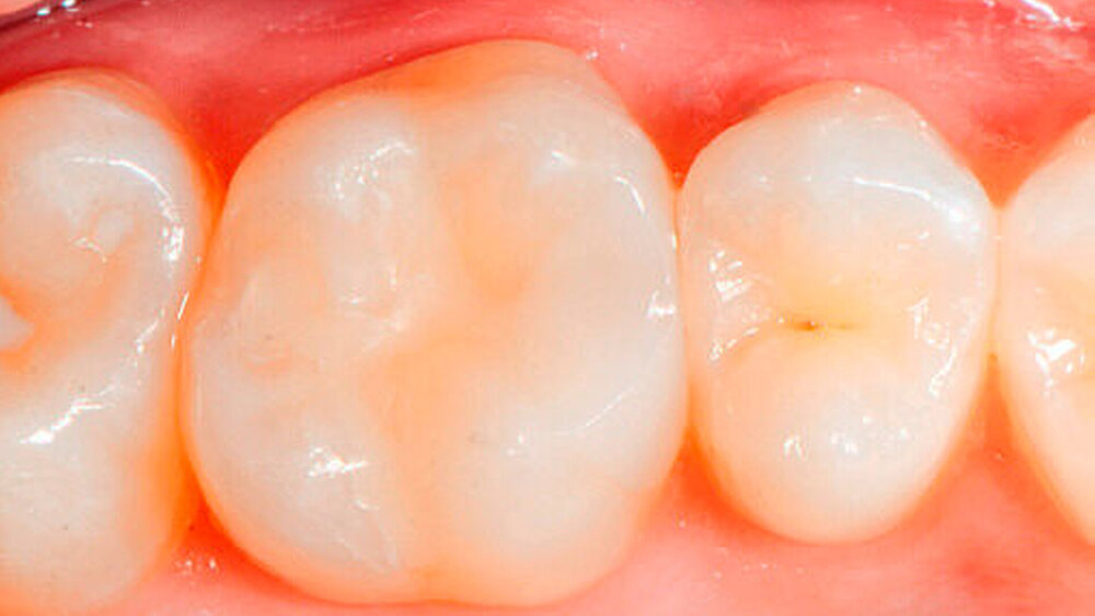Abbildung 11: Behandlungsergebnis nach dem adhäsiven Zementieren des minimal- invasiven Inlays |
