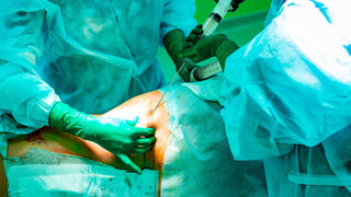 cosmetic liposuction surgery in actual operating room setting showing surgeon hands and cannula