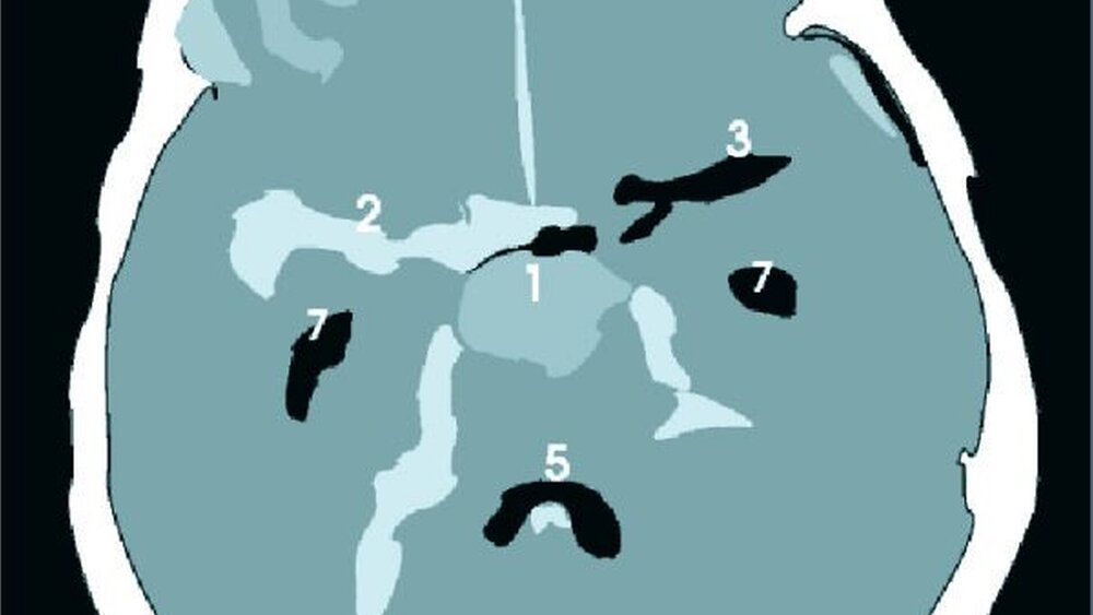 Abbildung: Subarachnoidalblutung (Kontraindikation Lyse): Das Aneurysma (1) ist in diesem Fall sehr groß. Das Blut des geplatzten Aneurysmas hat sich in den umgebenden Zisternen ausgebreitet (2 = Cisterna valleculae cerebri, die sich aber auf der linken Seite (3) weitgehend frei darstellt). Das Blut hat sich im schmalen Subarachnoidalraum weit verteilt. Zeichen für den erheblichen Befund sind die Blutnachweise im Interhemisphärenspalt (4) und auf einzelnen Hirnwindungen (Gyri) (6) der rechten Hirnhälfte (rechte Hemisphäre, Frontalhirn). Außerdem ist eine Einblutung in die IV. Hirnkammer (Ventrikel) dargestellt (5). |