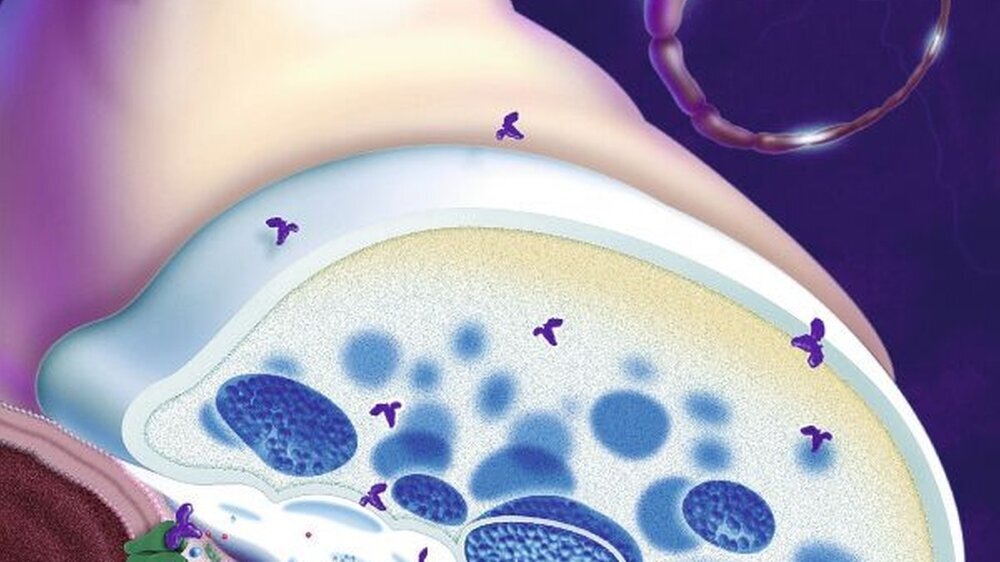Modell der gestörten Transmitterfunktion, die bei der Myasthenia gravis vorliegt