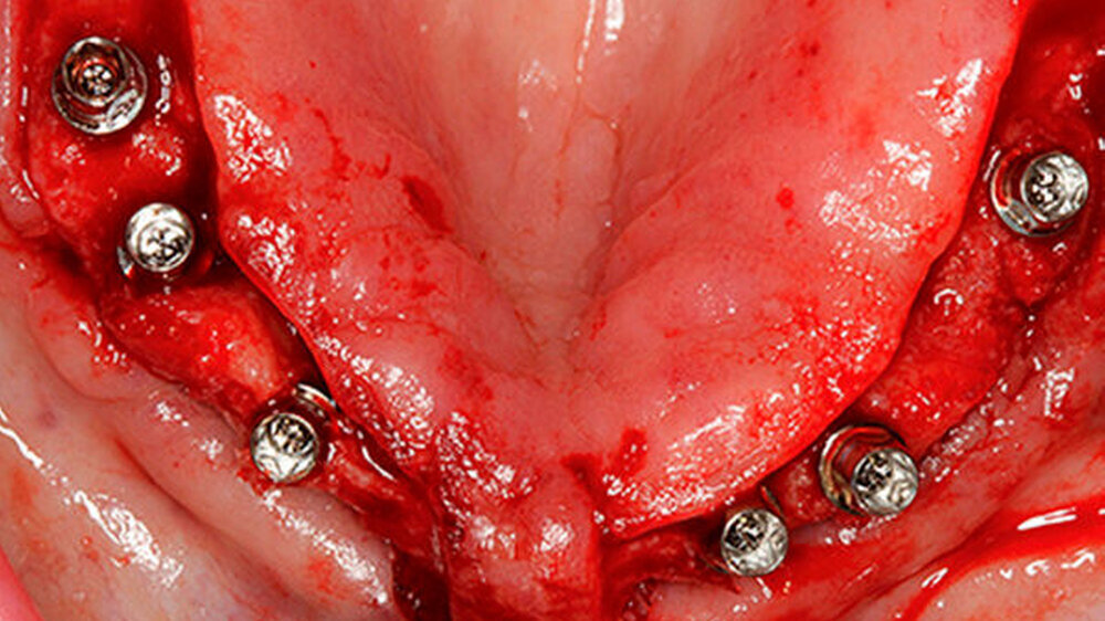 Implantation