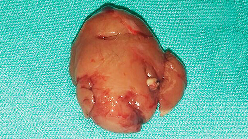 Abbildung 2: Makroskopische Aufsicht des entnommenen Präparats, das sich bei vorsichtiger Eröffnung als solide darstellte |