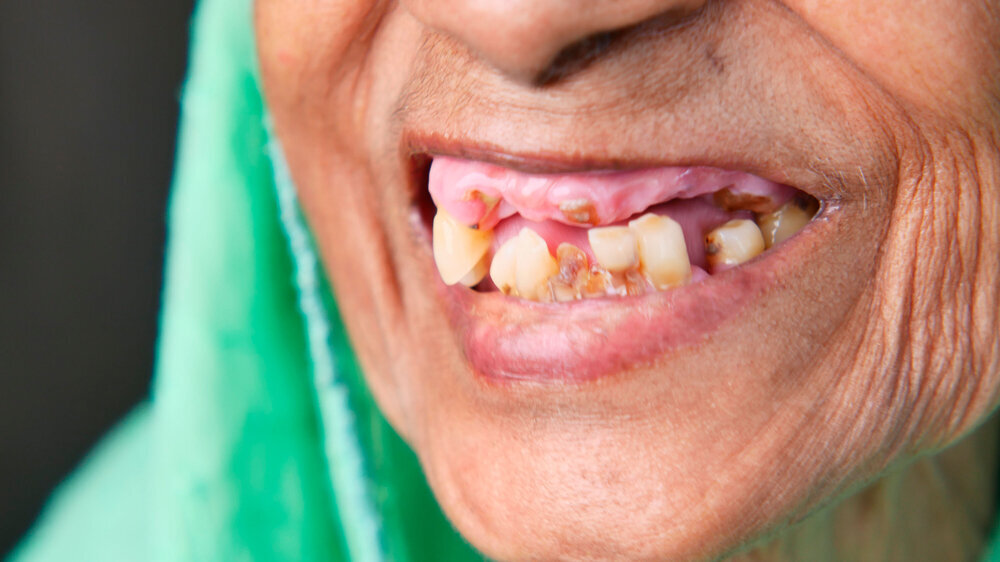 close up of senior women's dental caries and some broken teeth close up of senior women's dental caries and some broken teeth .