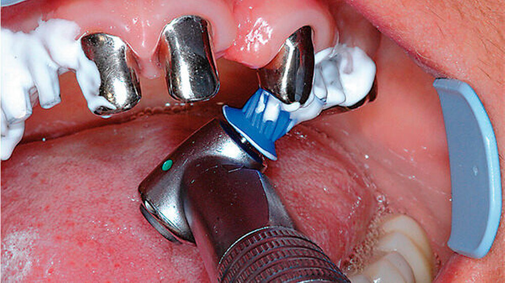 Die Patientin wurde mit Camlog-Implantaten aus Titan an 12, 12, 24 und 25 versorgt. Die Implantate 24, 25 werden hier mit der neuen REMOT Implant-Paste poliert.