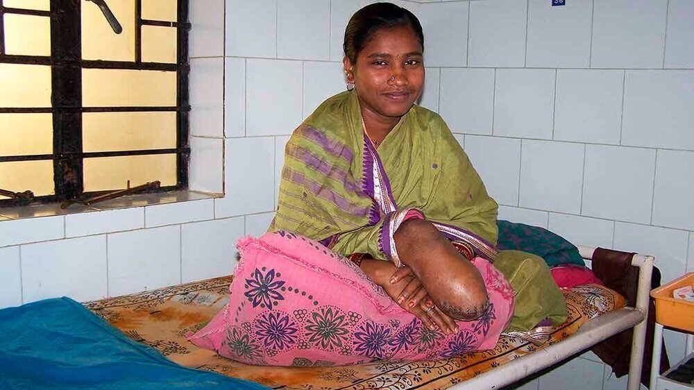 In der Lepraklinik in Indien brauchen Betroffene, die aufgrund ihres Schicksals oft aus der Gesellschaft ausgestoßen werden, dringend Hilfe.