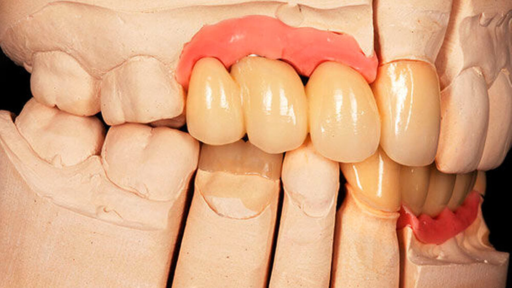 Abbildung 1: Fehlpositionierung eines Implantats im Interdentalraum