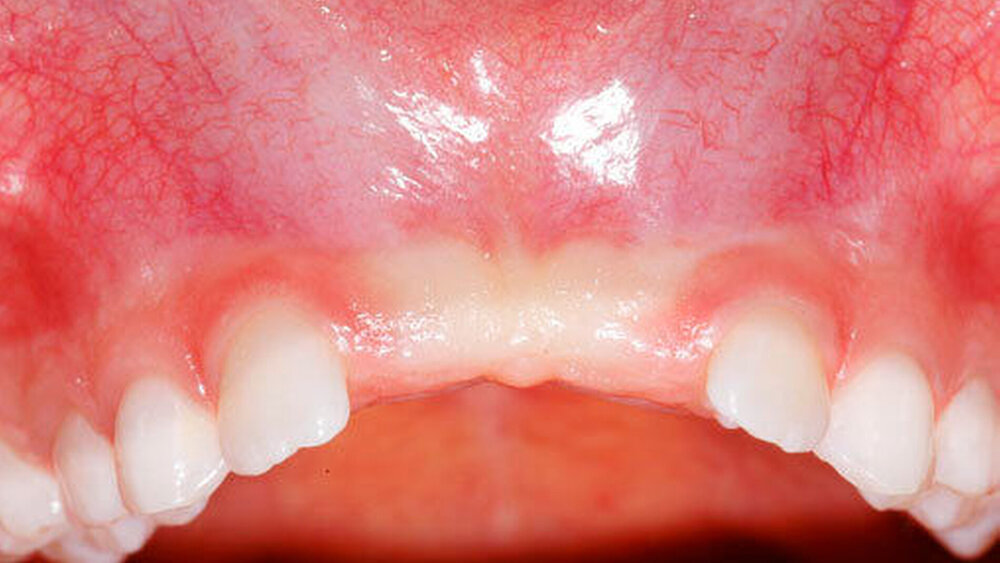 Abbildungen 13 bis 15: Behinderung und deutliche Verzögerung der normalen Eruption der zentralen Inzisiven im Oberkiefer aufgrund überzähliger Zähne (11+ und 21+) bei einer knapp neunjährigen Patientin (15: intraorale Ansicht). |