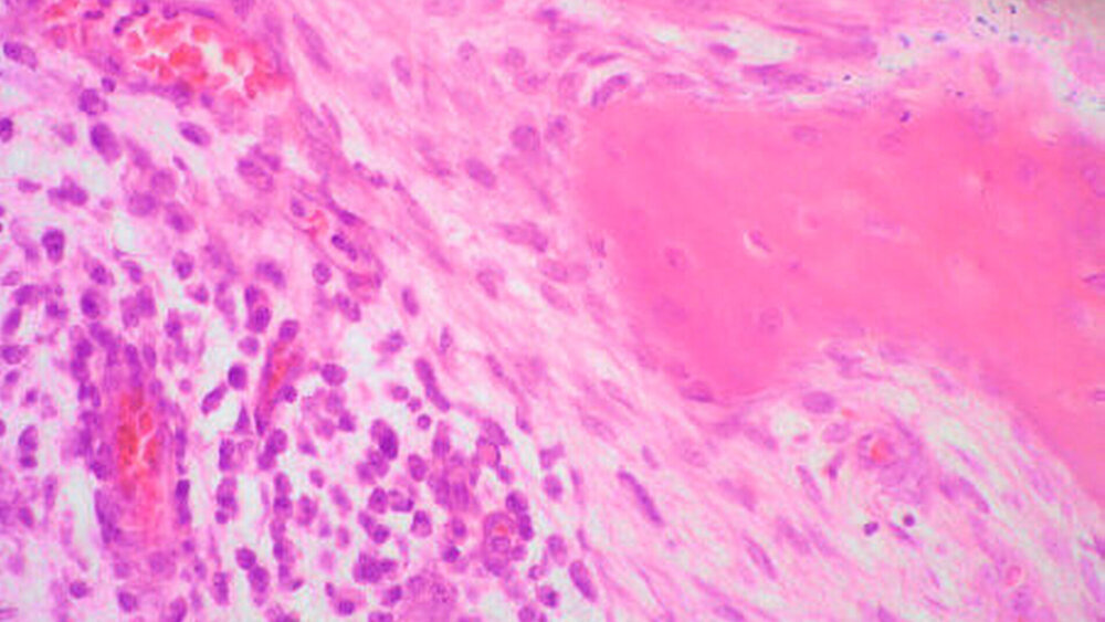 Abbildungen 6a und 6b: Histopathologisches Präparat in HE mit Darstellung der Markraumfibrose (a) bei 200-facher Vergrößerung. In der Ausschnittsvergrößerung (b) bei 400-facher Vergrößerung ist deutlich die lymphozytäre Infiltration zu erkennen. |