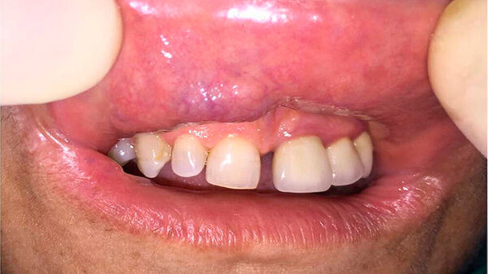 Abbildung 2: Bei der intraoralen Untersuchung zeigten sich eine leichte bläuliche Verfärbung und Erhebung im Bereich der Lippenschleimhaut.\r\n