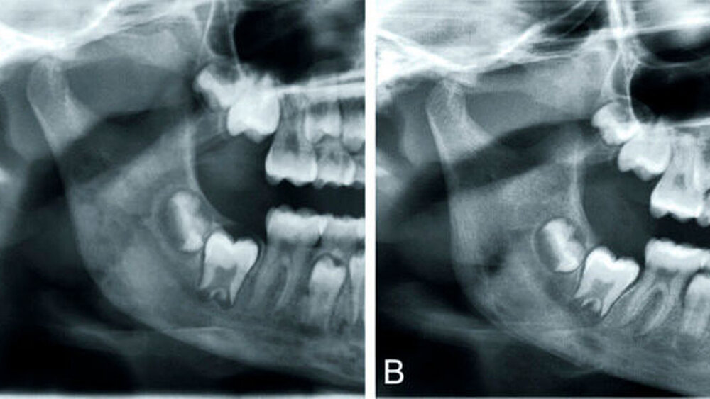 Abbildung 3: Panoramaschichtaufnahme einer jugendlichen Patientin mit CRMO: Zwischen beiden Aufnahmen liegen sechs Monate und ein klinisch symptomfreies Intervall. Die unruhige Darstellung des Knochens mit osteolytischen Arealen im Collumbasis- und im Corpusbereich Regio 44 bis 46 (A) zeigt sich nach sechs Monaten harmonischer (B), allerdings finden sich sklerotische periostale Randanbauten basal im Kieferwinkelbereich (B). |