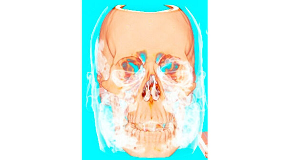 Die dreidimensionale Rekonstruktion des CT-Scans zeigt die eingeschlossene Luft im Kopf- und Halsbereich.