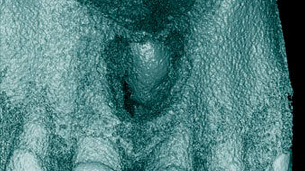 Abbildung 19: Überzähliger Zahn im Oberkieferfrontbereich (21+) mit zystischer Erweiterung des Zahnsäckchens und radiologisch erkennbarer Resorption der mesialen Wurzel von 11 bei einem 46-jährigen Patienten (d: 3-dimensionale Bildrekonstruktion). |