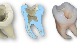 Konstruktion eines Übungszahns (v.l.n.r.): Übersicht des ganzen Zahns bestehend aus Schmelz und Dentin, Querschnitt des Zahns, kompletter im 3-D-Druckverfahren hergestellter Zahn