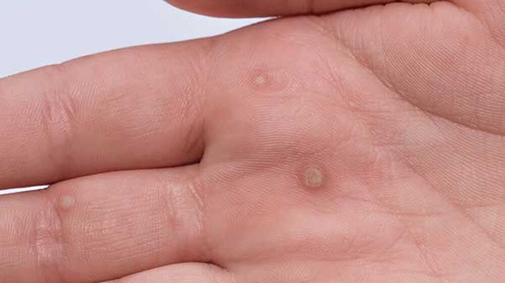 Resultat einer Infektion mit Humanen Papillomviren (HPV)