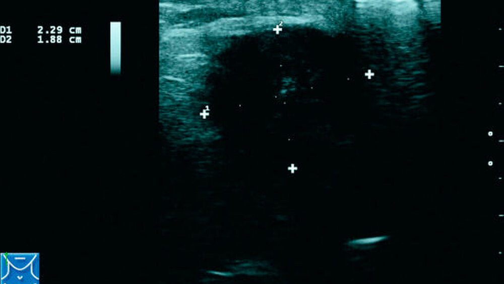 Abbildung 3: Präoperative B-Mode-Sonographie. Sonographisch zeigte sich eine partiell schlecht abgrenzbare, nicht komprimierbare Raumforderung mit echoarmem Binnenecho. |