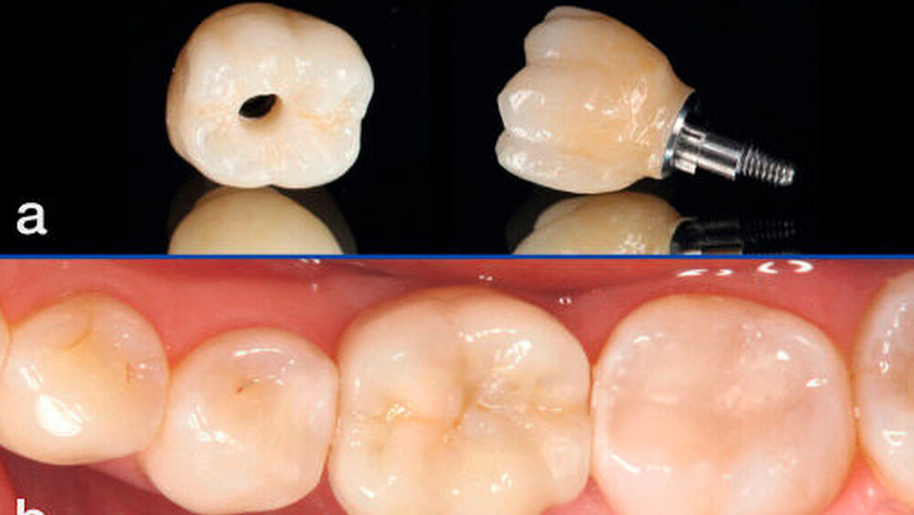 Abbildung 6: Fertiggestellte Restaurationen aus Lithiumdisilikatkeramik mit einem Titaninterface (a), klinische Situation nach der Eingliederung der okklusal verschraubten Implantatkrone (b): Der Schraubenkanal wurde adhäsiv mit einem Komposit-Inlay verschlossen. |