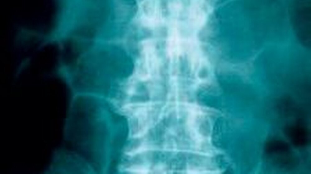 Dieser Morbus Bechterew- Patient zeigt Veränderungen an der Wirbelsäule zur Bambusstab-Wirbelsäule.