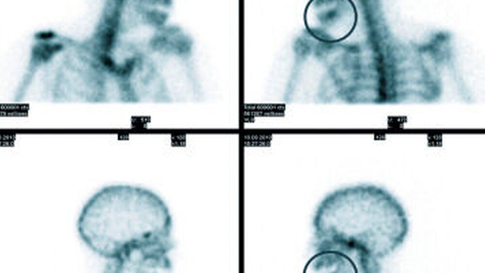 Abbildung 2: SPECT-Untersuchung der Patientin von Abbildung 1: Deutliche Aktivitätszeichen Regio 36 (Kreis) als Zeichen einer entzündlichen Reaktion. Die Extraktion lag über fünf Monate zurück. |