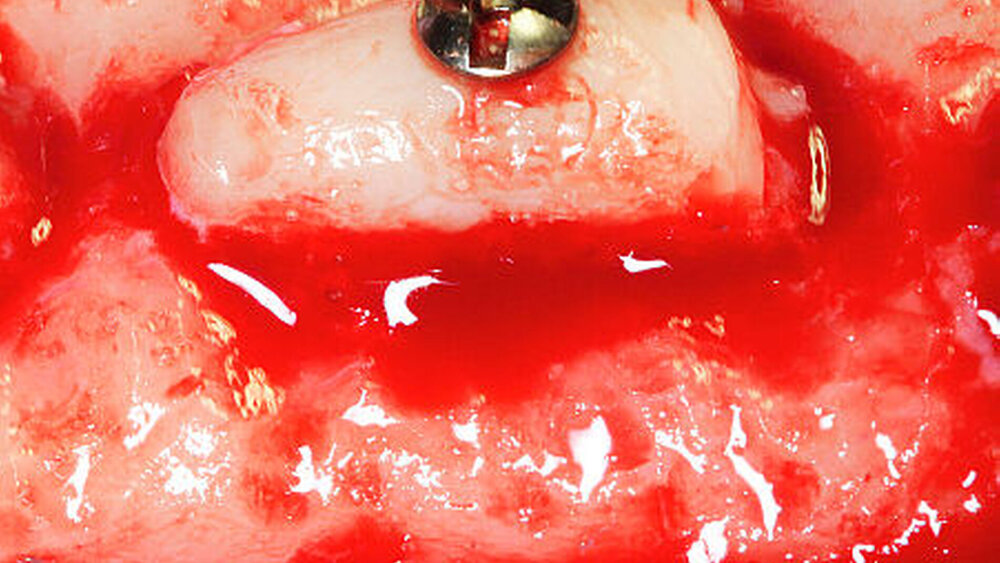 Abbildung 2a: Laterale Augmentation eines chronischen Kieferkammdefekts unter Verwendung einer Zahnwurzel (Tiermodell). Die Wurzel wird analog zu autogenen Knochenblöcken mittels einer Osteosyntheseschraube fixiert. |