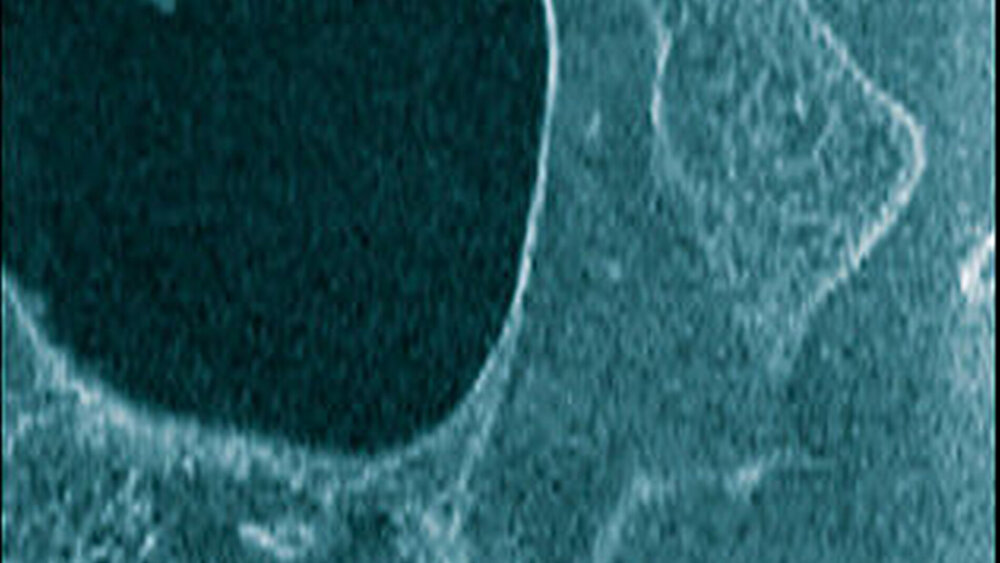 ... und sagittaler Schichtung (3c) mit Arrosion der vestibulären Knochenlamelle im Oberkiefermolarenbereich mit partiell zystischen, enossalen Strukturen |