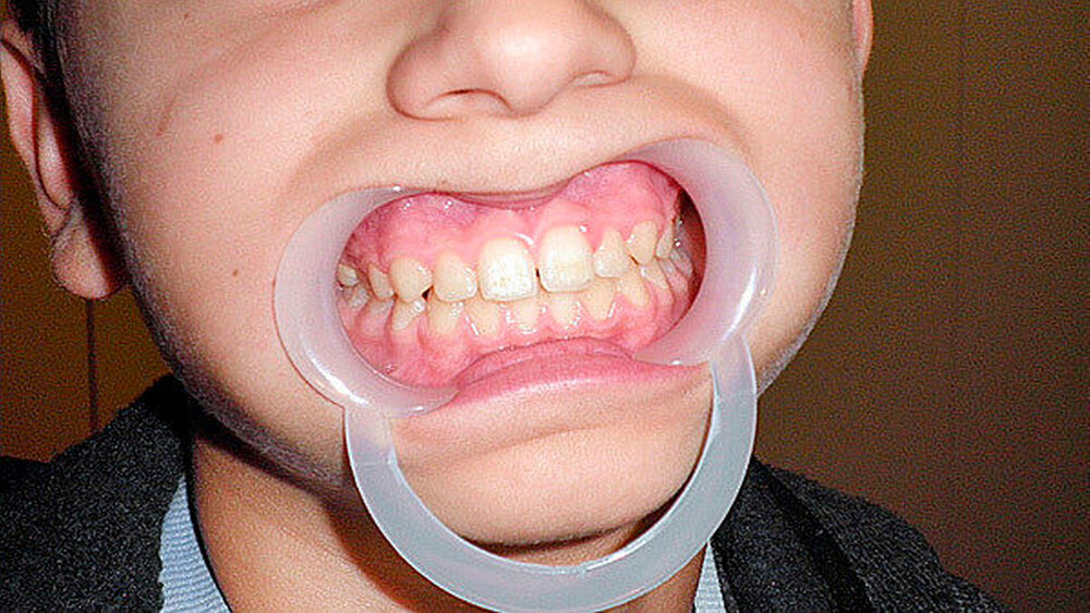 Abbildung 4: Nach der einjährigen IMT ist keine KFO-Behandlung mehr nötig. Die Kräftigung des M. orbicularis oris garantiert einen stabilen Mundschluss. Außerdem wurde ein physiologisches Schluckbewegungsmuster eingestellt. |