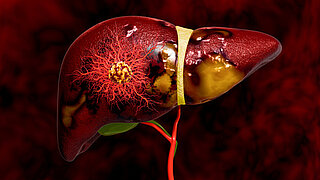 Progression from Healthy Liver to Fatty Liver and Liver Cancer Showing Tumor Growth, Angiogenesis, Cellular Invasion, and Disease Development from Metabolic Disorders 3D Rendering
