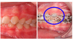 Abbildung 1: Substanzverlust im Zahnschmelz an 23 infolge Abrasion gegenüber Keramikbrackets |