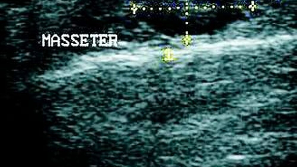 Abbildung 1: Sonographischer Befund der Raumforderung. Der horizontale Querschnitt zeigt einen scharf begrenzten, echoarmen, rundlichen Tumor im Bereich des rechten Musculus masseter.