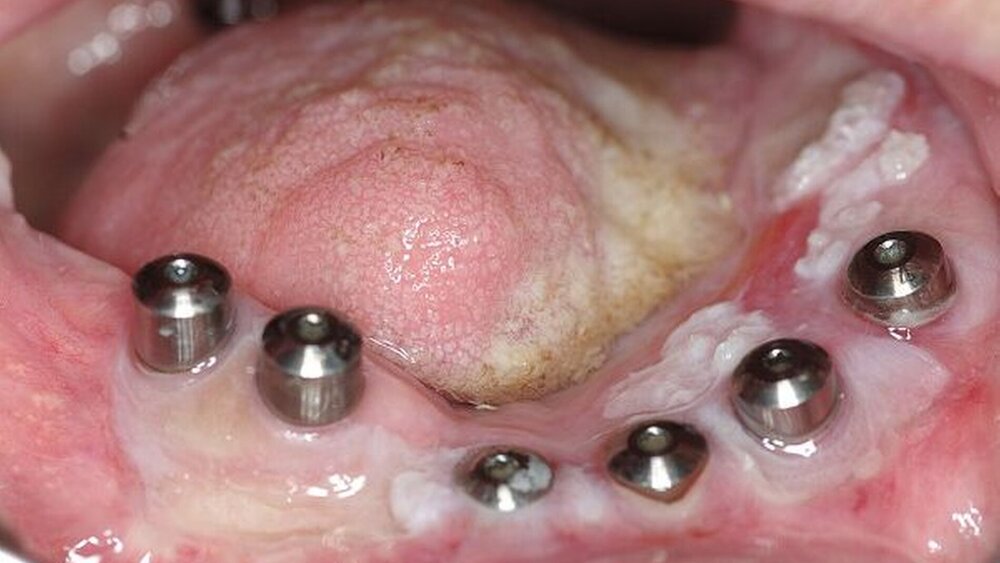 Abbildung 7: Ausgangssituation Unterkiefer: Die sechs Implantate (Brånemark) wurden bereits freigelegt und mit Einheilkappen versorgt. |
