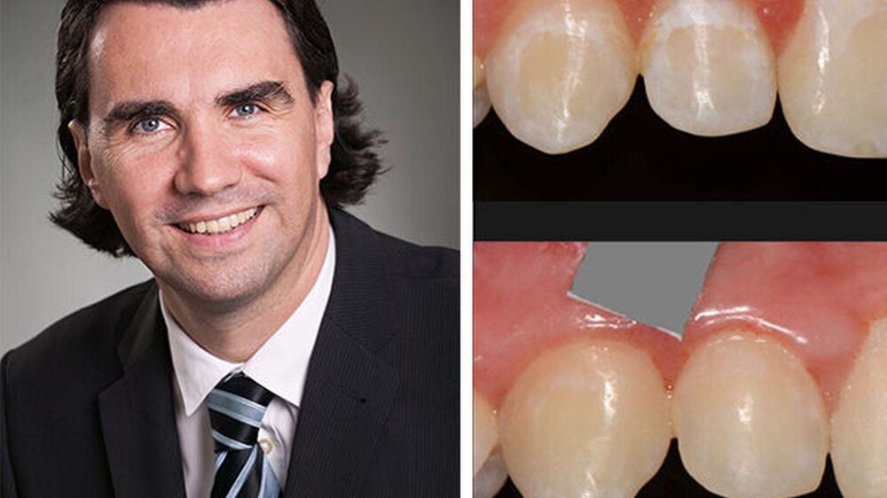 Univ.-Prof. Dr. Hendrik Meyer-Lückel wechselt von Aachen in die Schweiz. Der Mitbegründer der mikroinvasiven Kariesinfiltration tritt die Nachfolge von Prof. Dr. Adrian Lussi an. (Im Bild der Vorher-Nachher-Vergleich: White Spots bleiben häufig nach de
