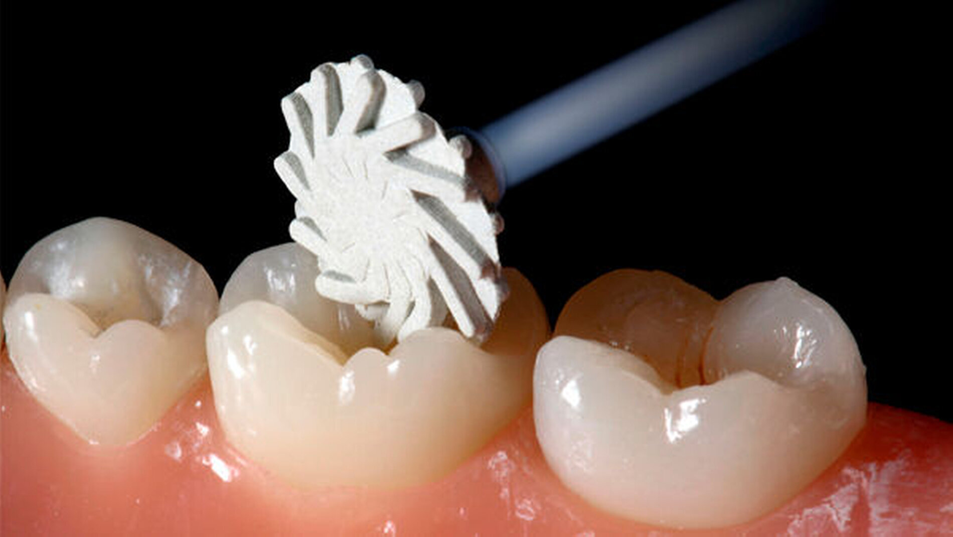 DENTSPLY ceram.x gloss für das perfekte Finish