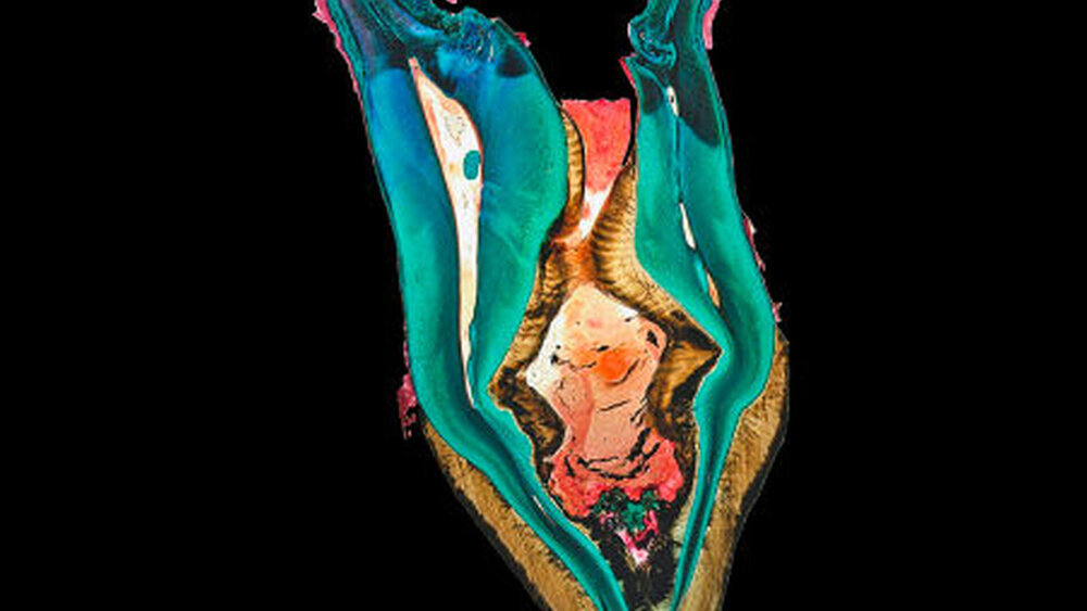 Abbildung 3: Schnitt durch die Vertikalebene des Dens invaginatus von den Abbildungen 2a und 2b: Struktur und Dicke der Schmelzauskleidung sind vor allem im koronalen Bereich der Invagination irregulär. |
