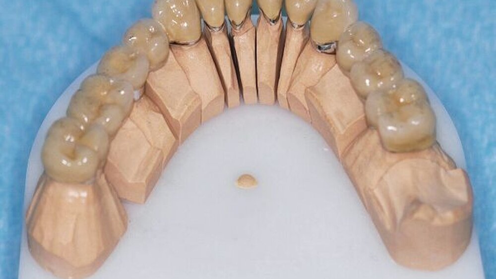 Abbildungen 15a, 15b, 15c: Vollständig verblendete und mit Glasurbrand versehene Kronen und Brücken sowie fertiggestellte partielle obere Prothese vor der definitiven Fixierung. |