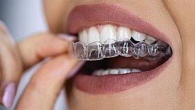 Aligner