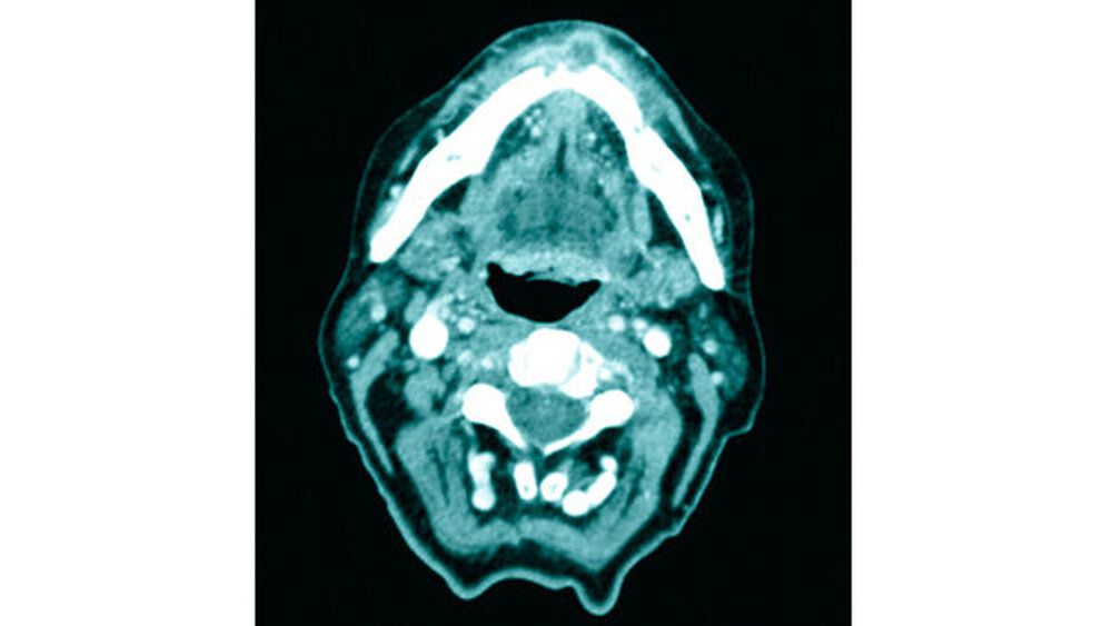 Abbildung 4: Axiale Computertomografie im Weichteilfenster mit eindeutigen Hinweisen für das Vorliegen eines Malignoms: Es zeigt sich eine Kontrastmittelanreicherung vestibulär bis ins subkutane Fettgewebe reichend. |